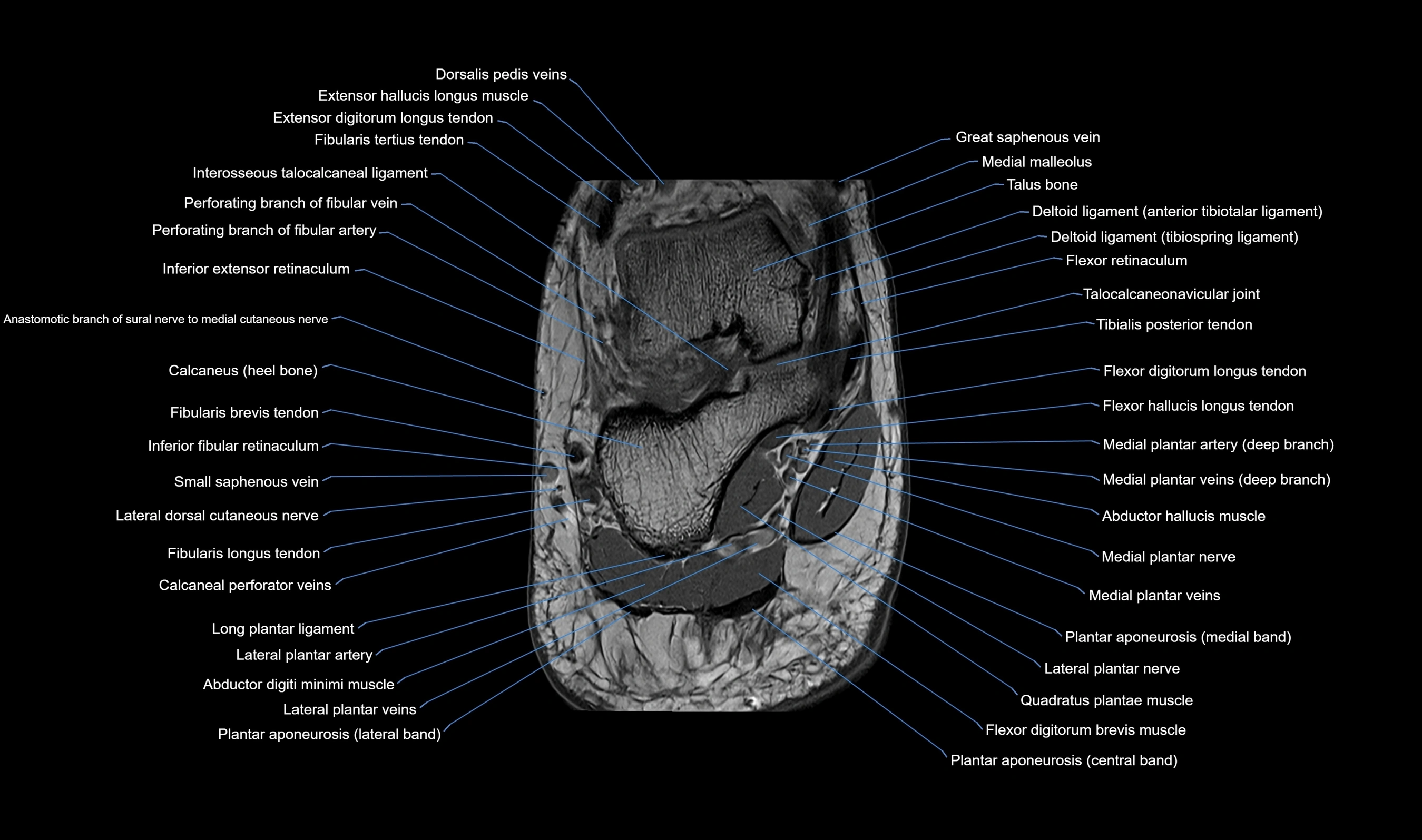 MRI mid foot axial cross sectional anatomy 3T  radiology  image-img-00001-00045.webp